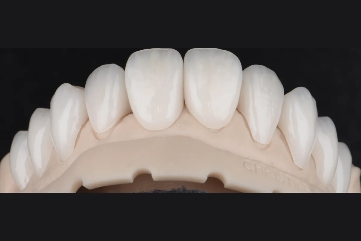 Upper anterior restorations seated on a stone model