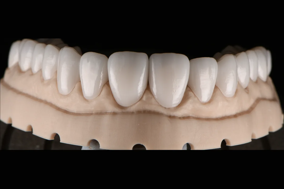 A full upper arch of anterior restorations, front view on the model