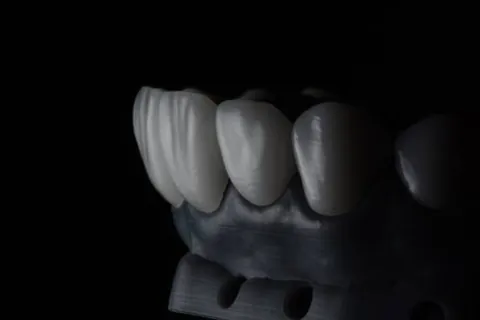 Zirconia bridge seated on a dark model